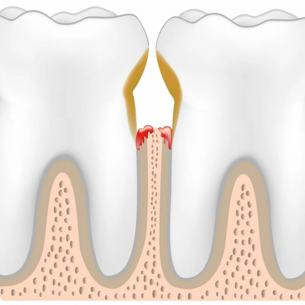 lechenie-parodontita